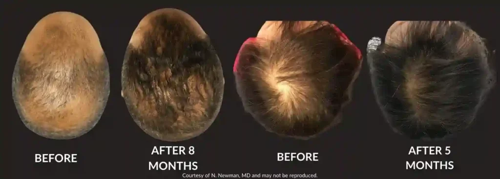 before and after derive hair restoration